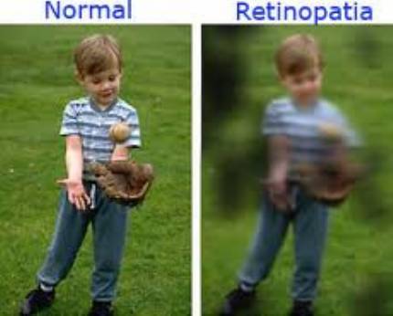 Retinopatia Diabtica: Um Assunto Pouco discutido Mais muito importante 