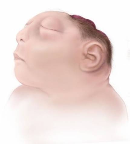 Saiba mais sobre Anencefalia Fetal 