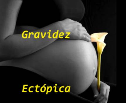 Gravidez Ectpica 