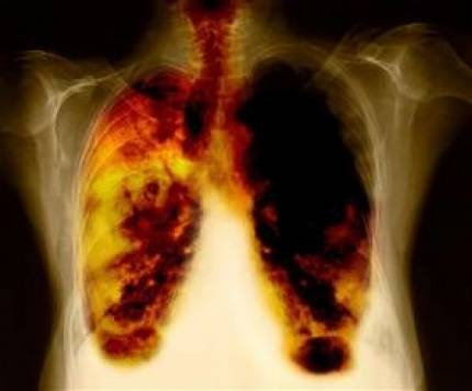 Saiba mais sobre Enfisema Pulmonar ! 