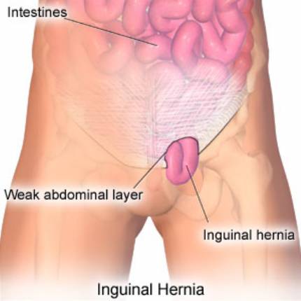 Voc sabe o que  Hernia Inguinal ? Tire suas dvidas  