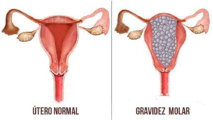 CONHEA MAIS  SOBRE GRAVIDEZ MOLAR 