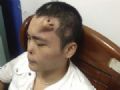 Cirurgies chineses fazem crescer ''nariz'' artificial na testa de paciente Xiaolian se prepara para o transplante do novo rgo, que cresceu na sua testa a partir do implante de um expansor de tecido e com pedao de cartilagem da costela. (Foto: Reuters/Stringer)
