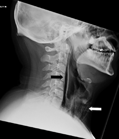 Em caso raro, homem rompe garganta e tem dificuldade para falar aps segurar espirro Setas indicam fratura na garganta aps espirro (Foto: BMJ Case Reports) 