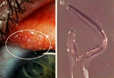  Mdicos retiram 14 vermes de um nico olho de mulher nos EUA  esquerda, sinais de vermes identicados no olho; na imagem da direita, a Thelazia aps ser enviada para laboratrio (Foto: American Journal of Tropical Medicine & Higyiene/CDC) 
